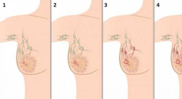 Etapy, typy a liečba rakoviny prsníka