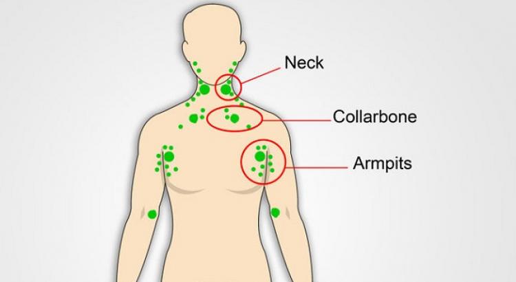 Entzündungssymptome der Lymphknoten im Nacken